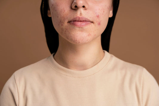 Voorkom acne effectief