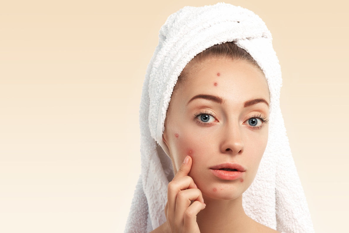 Anti-acne